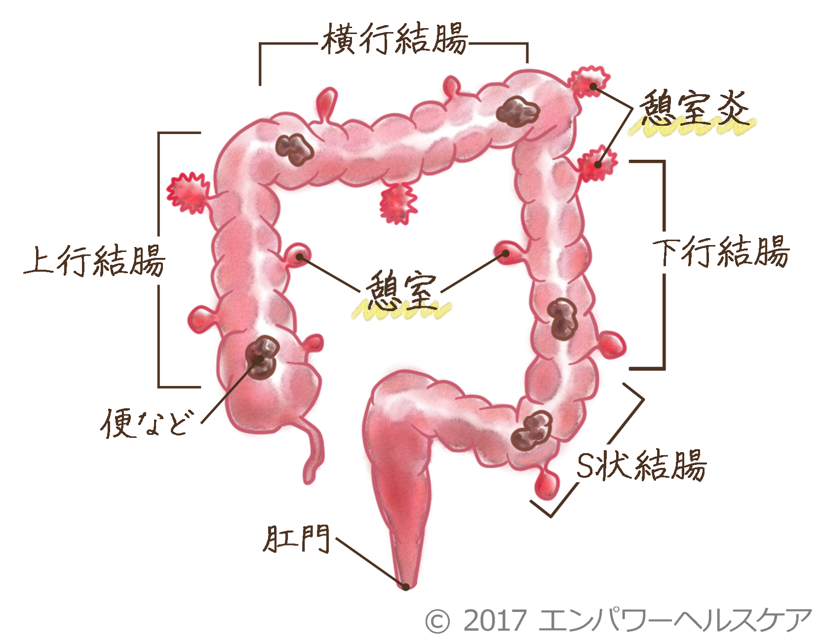 腸のイラスト（憩室炎の起きる部位）