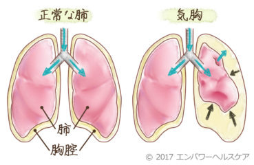 正常な肺と気胸のイラスト