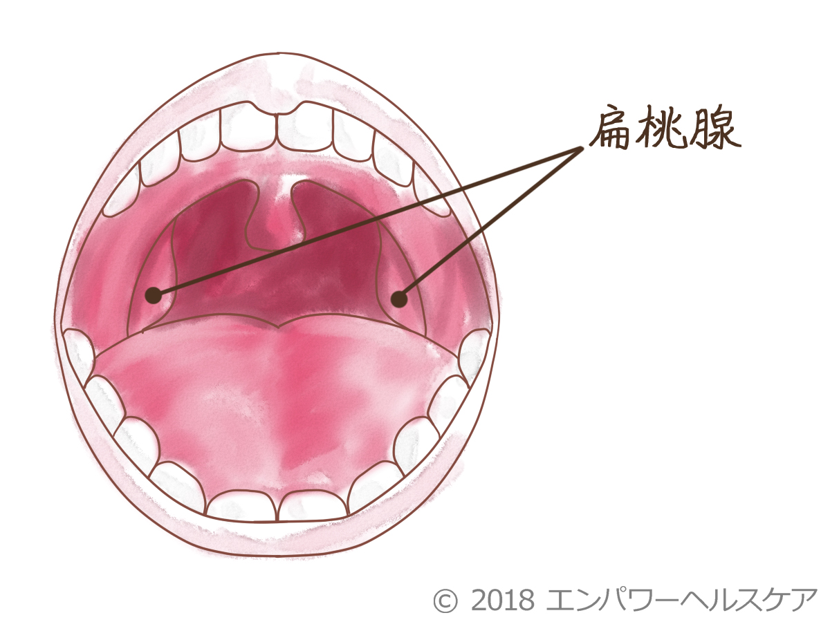 扁桃腺がんと扁桃炎はどのように治療されますか?