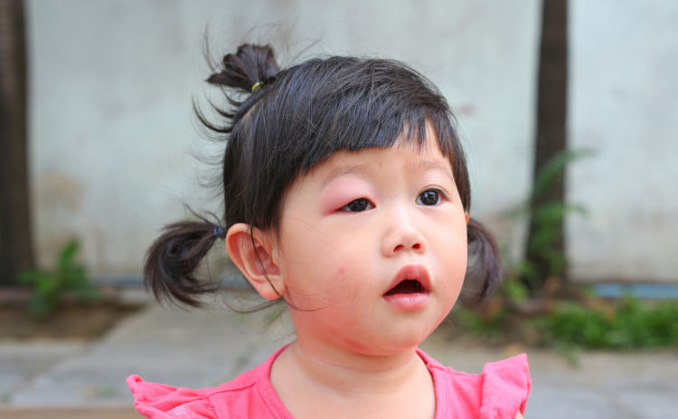 瞼が腫れる原因 赤ちゃんのまぶたが腫れぼったい！腫れる原因や腫れたときの5つの対応策
