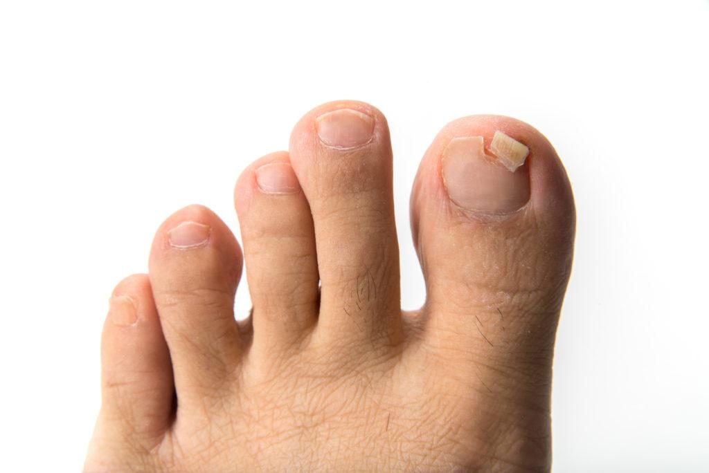 足の爪が剥がれた後の対処法